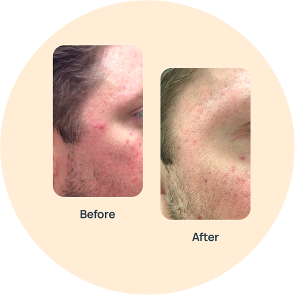 Rosacea Triple Cream image 0