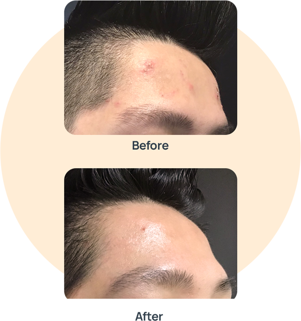 Acne Medication image 0
