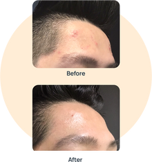 Acne Medication image 0