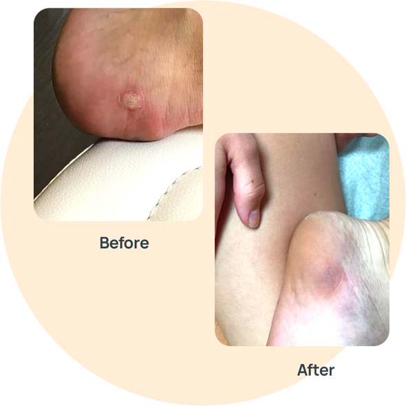 Wart Medication image 0