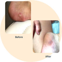 Wart Medication image 0