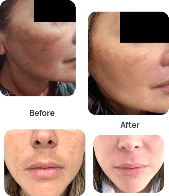 Melasma/Hyperpigmentation Medication image 0