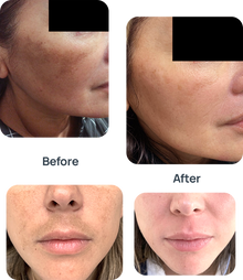 Melasma/Hyperpigmentation Medication image 0